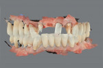 Fig 10. Scanned images of both jaws without the scan body in place on the dental implant (Fig 9) and with the scan body in place on the dental implant (Fig 10).
