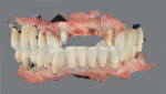 Fig 9. Scanned images of both jaws without the scan body in place on the dental implant (Fig 9) and with the scan body in place on the dental implant (Fig 10).