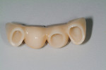 Fig 14. Porcelain-fused-to-zirconia fixed prosthesis, intaglio view.