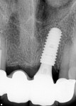 Fig 13. Verification radiograph of the custom abutment in place with the zirconia framework try-in.