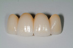 Fig 15. Porcelain-fused-to-zirconia fixed prosthesis, labial view.