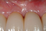 Fig 16. Final restoration at 1 week post cementation, close-up view.