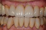 Fig 17. Final restoration at 1 week post cementation, retracted view.
