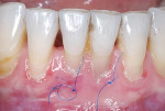 Fig 4. Two weeks after the free gingival graft procedure at No. 24, prior to suture removal.