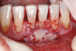 Fig 3. Free gingival graft sutured into place on tooth No. 24.