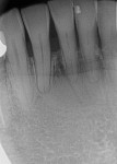Fig 6. Periapical radiograph of the mandibular anterior teeth 8 weeks postoperatively.