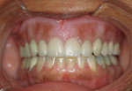 Figure 1  Turbyfill deluxe maxillary denture opposing natural dentition with African-American tinting.