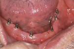 Figure 3  Mandibular occlusal view of six mini-implants.