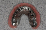Figure 5  Mini-implant–supported maxillary palate-less overdenture.