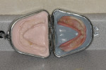 Figure 10  Lang duplicate of approved denture.