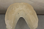 Figure 11  Clear duplicate of denture with BaSo<sub>4</sub> incorporated to be used for CAT scan, surgical guide, and impression tray.