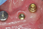 Figure 12  View of PME, BioHorizons external hex implant, and seated Locator attachment.