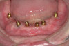 Figure 1  Frontal view of the failing maxillary left central incisor.