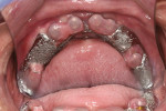 Figure 15  Try-in of mandibular Locator overdenture frame for verification of attachments prior to tooth setup.