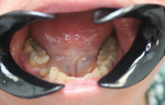 Fig 2. The patient presents with periodontitis for which periodontic treatment has proven ineffective.
