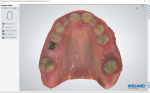 Fig 5. Digital scans of the maxillary and mandibular arches and the bite registration.