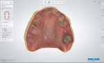 Fig 8. Digital software is used to design the restorations, incorporating a photo of the patient to match the design to her natural dentition.