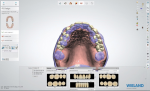 Fig 11. Digital software is used to design the restorations, incorporating a photo of the patient to match the design to her natural dentition.