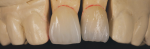 Fig 1. High Density Micronization technology helps provide GC Initial LiSi Press restorations more strength and better esthetics.