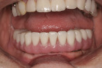 Figure 18  Frontal view of screw-retained hybrid.