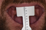 Fig 4. A papillameter measures the vertical distance between the alveolar ridge and the low and high lip lines.