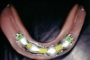 Figure 8  Completed crown on the maxillary left central incisor.