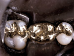 Figure 4  Seated and cemented cast-gold, stress-broken inlay bridge.