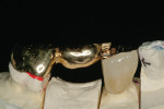 Figure 7  Two sections of full-crown-retained, stress-broken, cast-gold bridge with pressed porcelain facing (laboratory work by Dr. Bruce Small and Peny Marrazzo of StoneyBrook Noble Gold; Newtown, Pennsylvania.