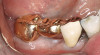 Figure 16  Failing maxillary right central incisor with fistula.