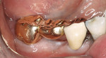 Figure 8  Mandibular cast-gold, stress-broken bridge with two full-crown abutments seated in the patient’s mouth.