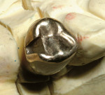 Figure 10  Anterior abutment of four-unit, cast-gold/porcelain bridge showing distal slot for stress breaker (laboratory work by Dr. Warren Johnson; Seattle, Washington).