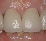 Figure 15  Two maxillary anterior porcelain-fused-to-gold crowns (laboratory work by Robert Posey; Posey Dental Laboratory; Langhorne, Pennsylvania).