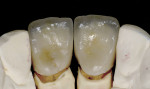 Figure 16  Lingual view of two porcelain-fused-to-gold crowns.