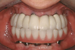 Figure 17   Retracted anterior view of cemented full-arch PFM bridge cemented to implants (laboratory work by Artistic Dental Studio; Bolingbrook, Illinois).