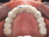 Figure 26  Fractured maxillary left central incisor with fistulous tract.