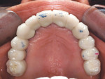 Figure 18  Occlusal view of cemented full-arch PFM bridge on implants prior to occlusal adjustment.