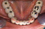 Figure  19  Occlusal view of implant bridges with malpositioned implant access openings.