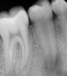 Preoperative periapical radiograph of an immature permanent tooth (No. 29) with necrotic pulp.