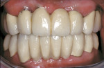 Figure 21  Seated PFM bridges: maxillary on implants, mandibular on natural teeth.