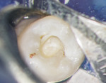 Bioceramic material placed over the collagen plug on tooth No. 29.