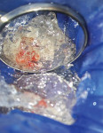 Placement of sterile shaved ice over a direct pulp exposure on tooth No. 19.
