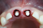 Occlusal view of one-piece zirconia implant
placement.