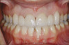 Figure 32  Provisional crown on tooth No. 9, 3 months after the block graft, with tissue grooming completed. Note the central incisor width discrepancy to be corrected with veneer to tooth No. 8.