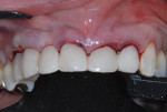 mmediate postoperative clinical view of the provisional restoration.