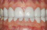 Figure 27  Seated and bonded lithium-disilicate crowns (laboratory work by Artistic Dental Studio; Bolingbrook, Illinois).