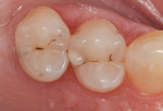 Preoperative photograph of teeth Nos. 4 and 5, showing caries.