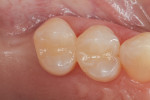 Postoperative photograph of teeth Nos. 4 and 5. An MOD restoration was placed on tooth No. 4, and a DO restoration was placed on tooth No. 5. The shade of these teeth is Vita A2.