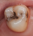Preoperative photograph of tooth No. 2 with failing amalgam restoration and the presence of caries on the mesial and distal marginal ridges. The preoperative shade of this tooth was Vita A3.5.