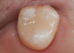 Immediate postoperative photograph of an MOD restoration on tooth No. 2. A thin layer of supplemental color blocking composite material was applied to the pulpal floor of the preparation to block discoloration
that was caused by the old amalgam.