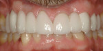 Figure 30  Seated and bonded zirconia-fused-to-porcelain bridges and crowns on teeth Nos. 4 through 13 (laboratory work by Artistic Dental Studio; Bolingbrook, Illinois).